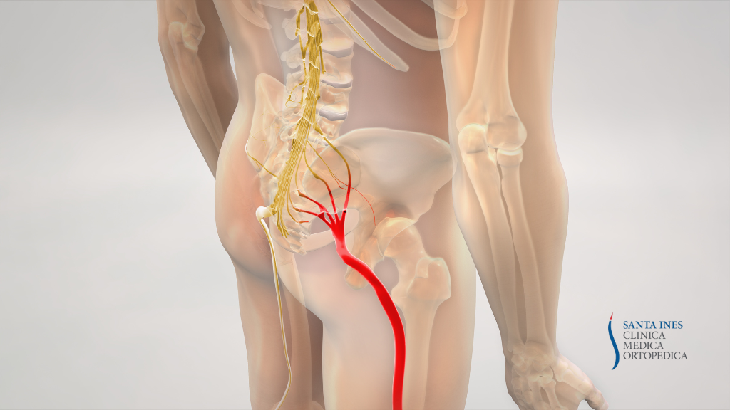 Lombosciatalgia e ozonoterapia: trattamento efficace per dolore e infiammazione